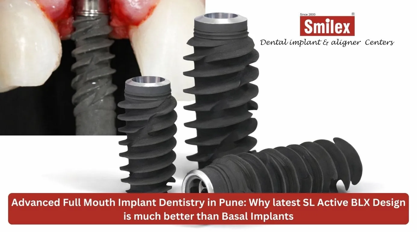 Full Mouth Implant Dentistry in Pune