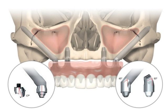 Zygomatic Dental Implants