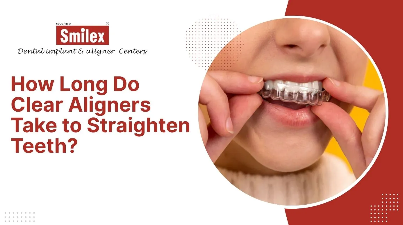Clear Aligners