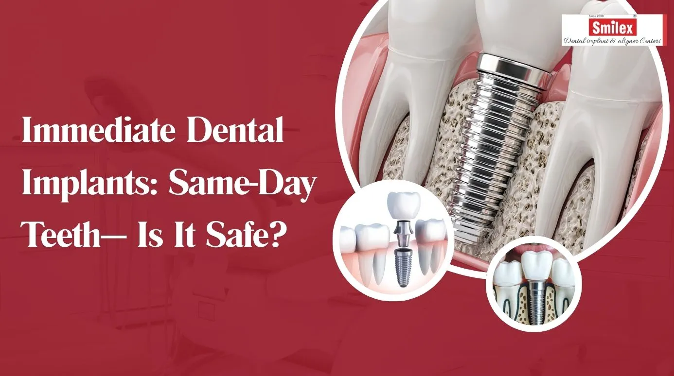 Immediate Dental Implants