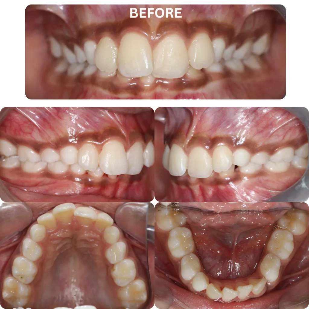 Invisalign First for Kids