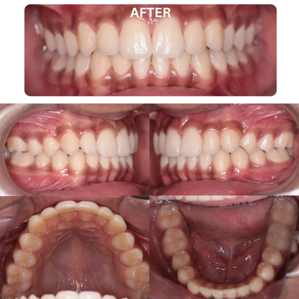 Invisalign First for Kids