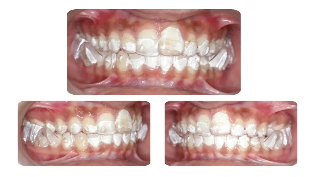 Mandibular Occlusal Blocks for Mandibular Advancement (MAOB)
