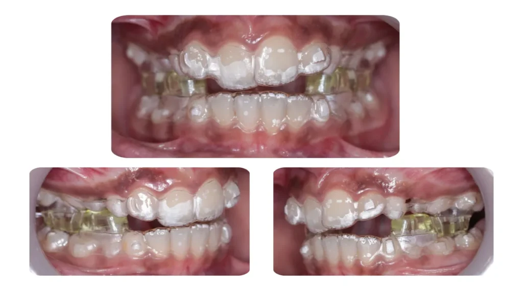 Mandibular Occlusal Blocks for Mandibular Advancement (MAOB)
