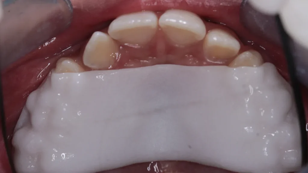  Invisalign Palatal Expander (IPE)