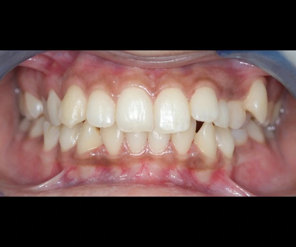Extra Tooth