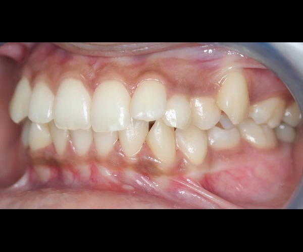 Extra Tooth