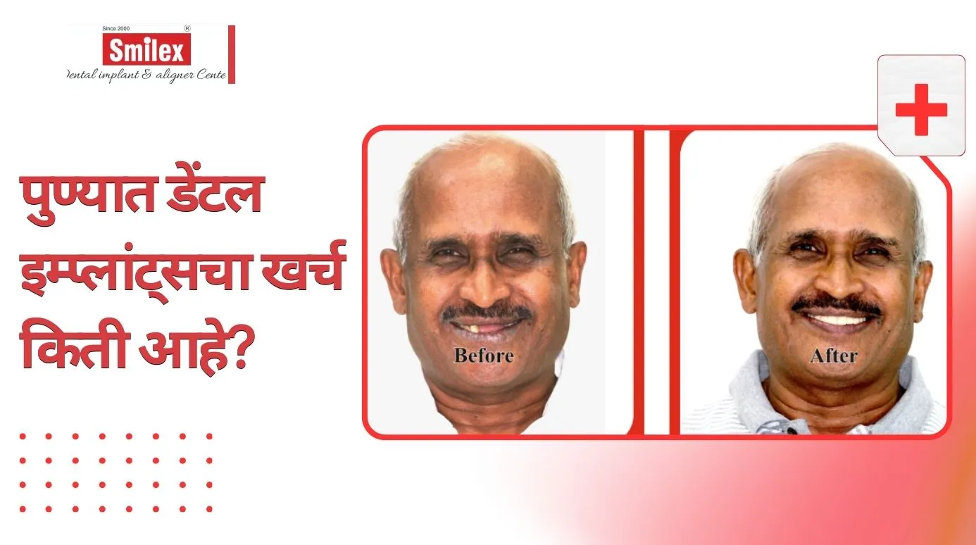 पुण्यात डेंटल इम्प्लांट्सचा खर्च किती आहे? (2026 अपडेट) 