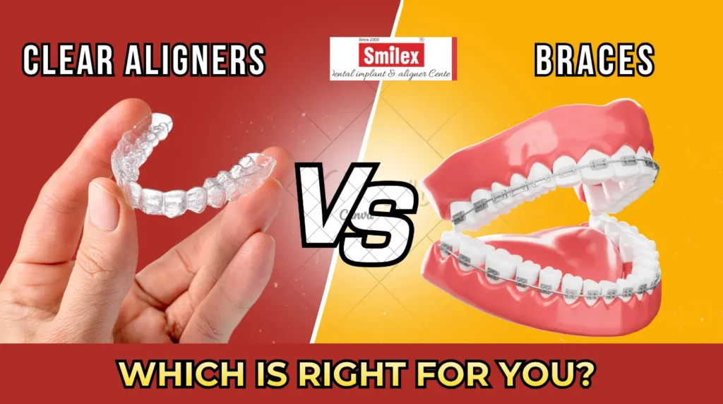 Clear Aligners vs Braces