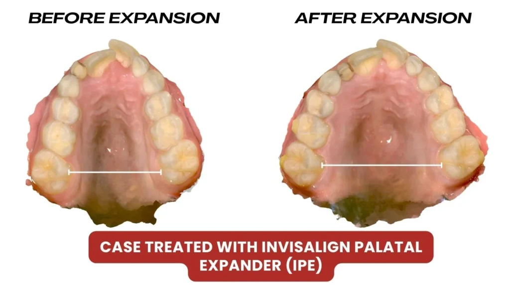  Invisalign Palatal Expander (IPE)