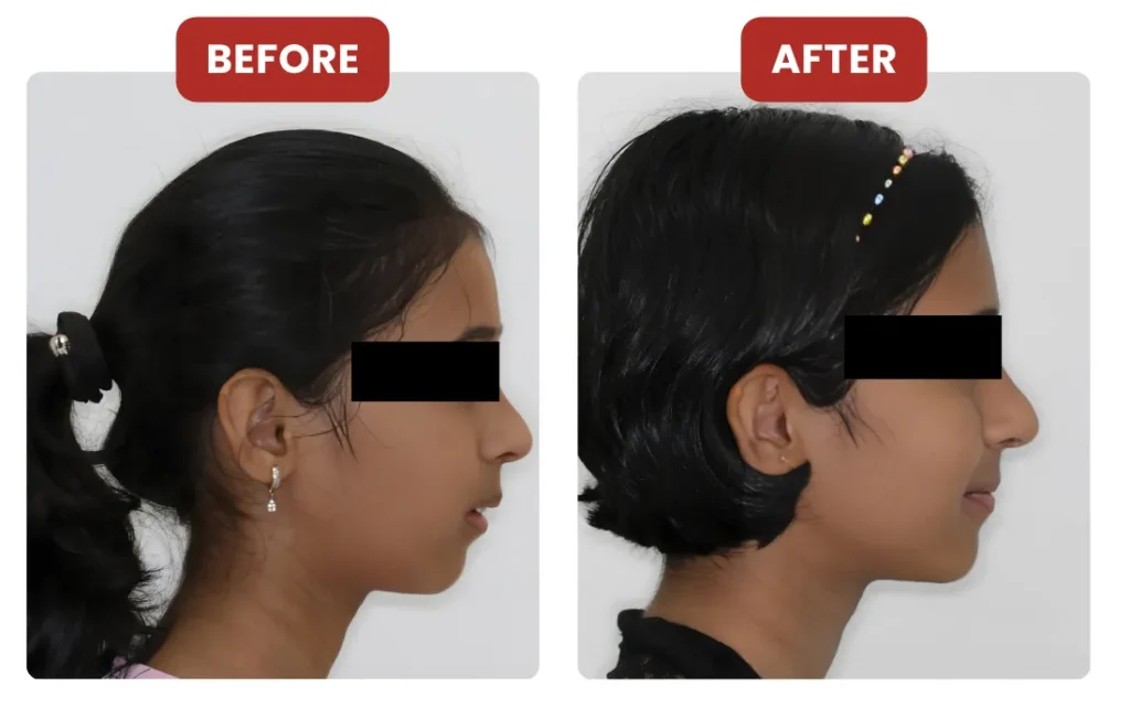 Mandibular Occlusal Blocks for Mandibular Advancement (MAOB)
