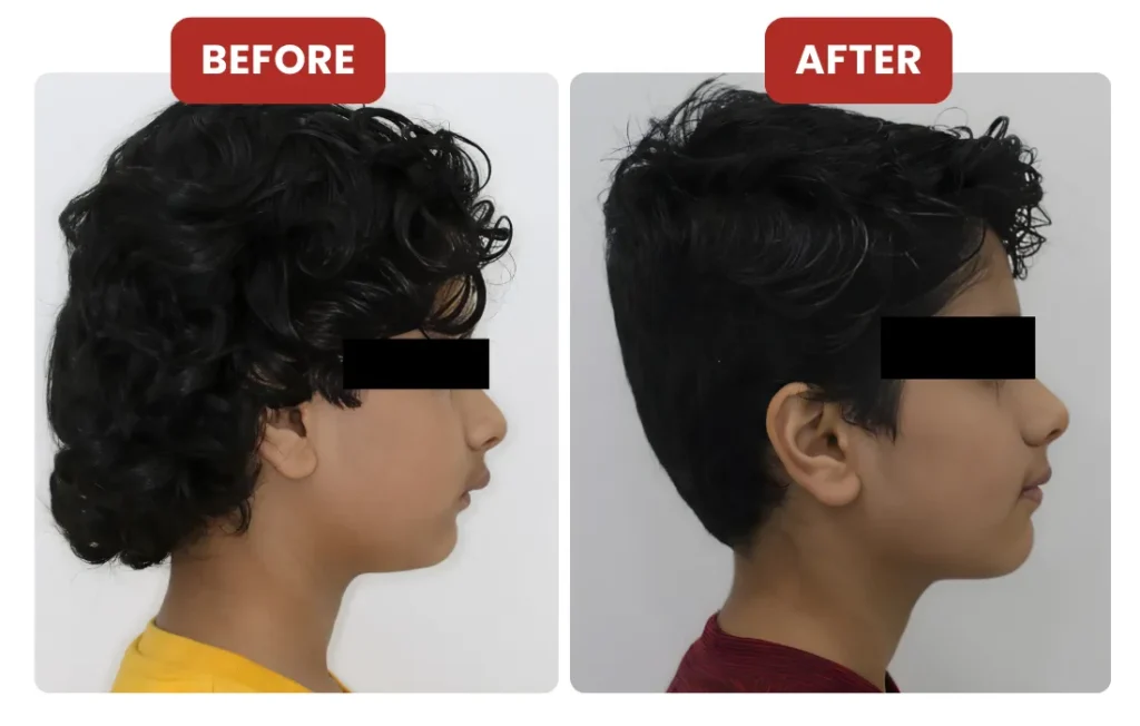 Mandibular Occlusal Blocks for Mandibular Advancement (MAOB)
