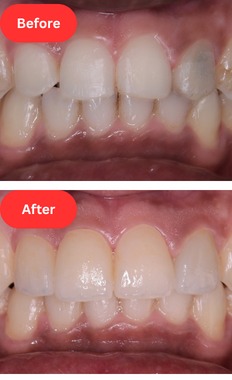 Dental veneers