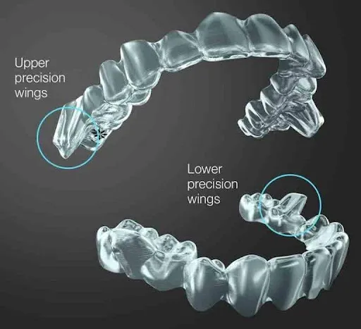 Mandibular Advancement with Precision Wings
