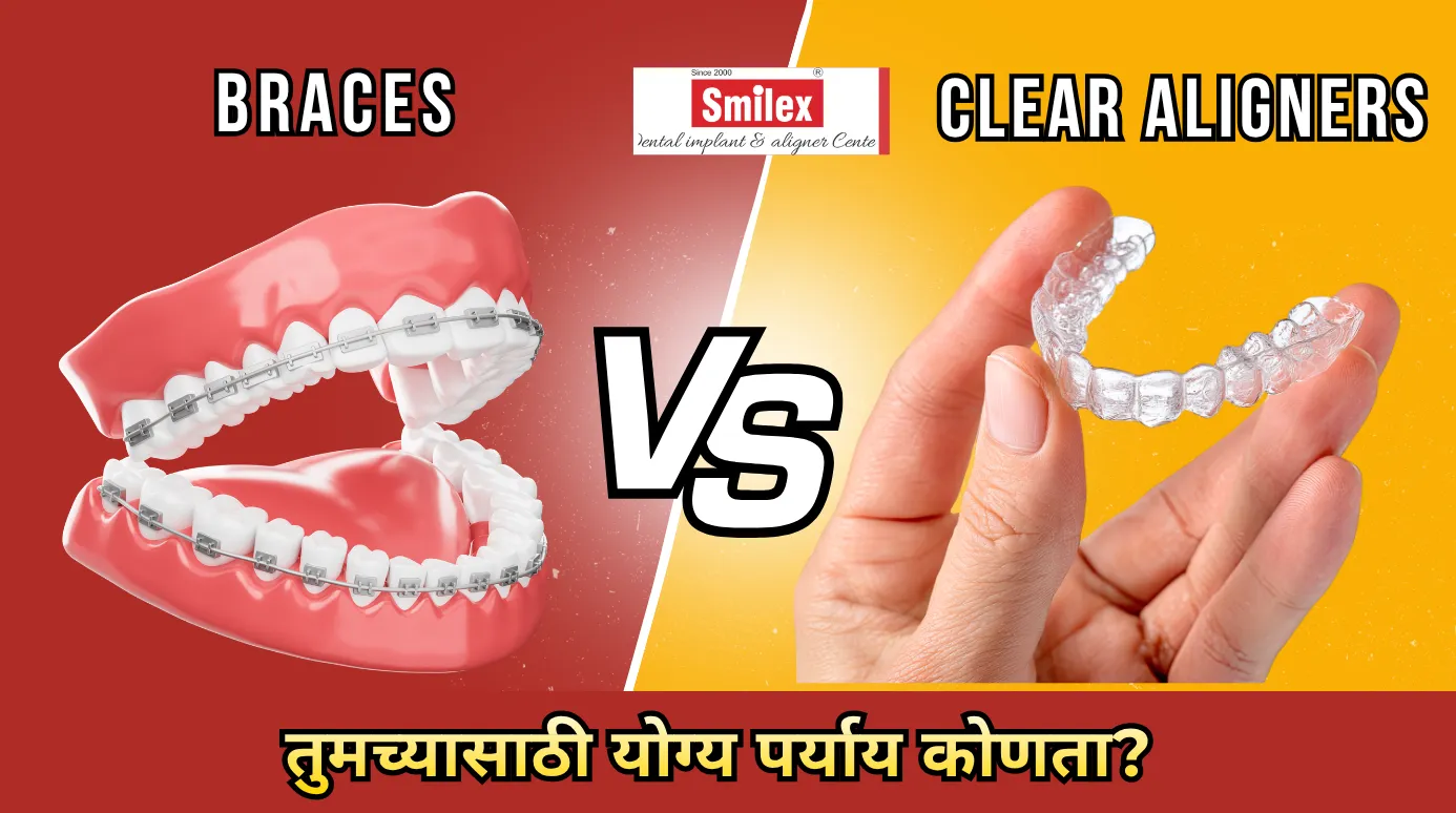 ब्रेसेस की अलायनर्स? तुमच्यासाठी योग्य पर्याय कोणता?