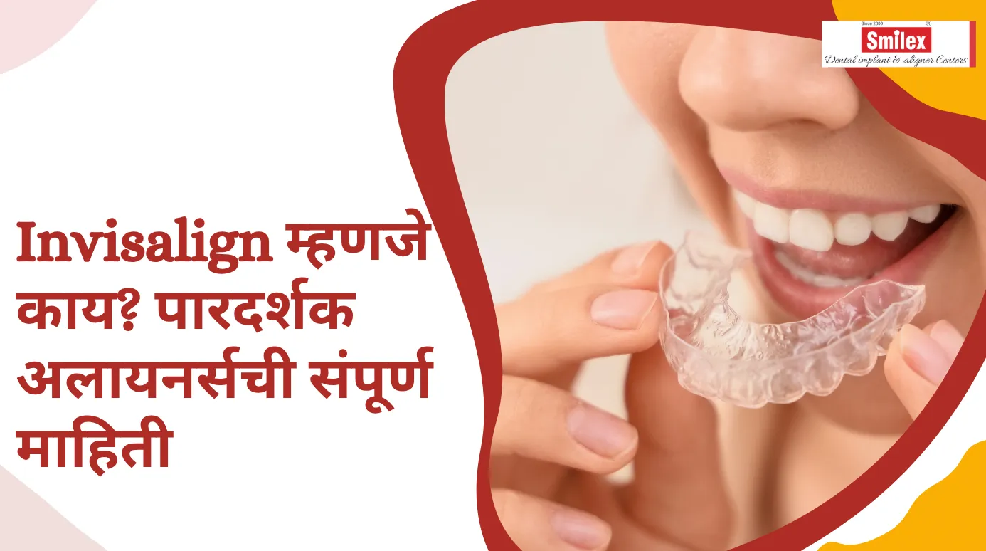 Invisalign म्हणजे काय? पारदर्शक अलायनर्सची संपूर्ण माहिती