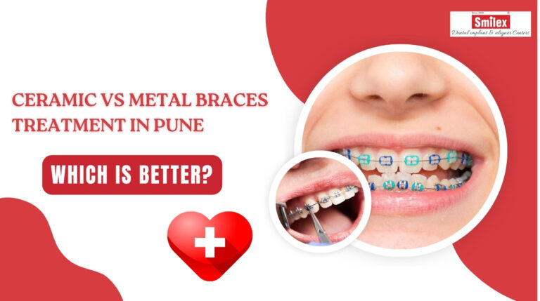 Braces Treatment