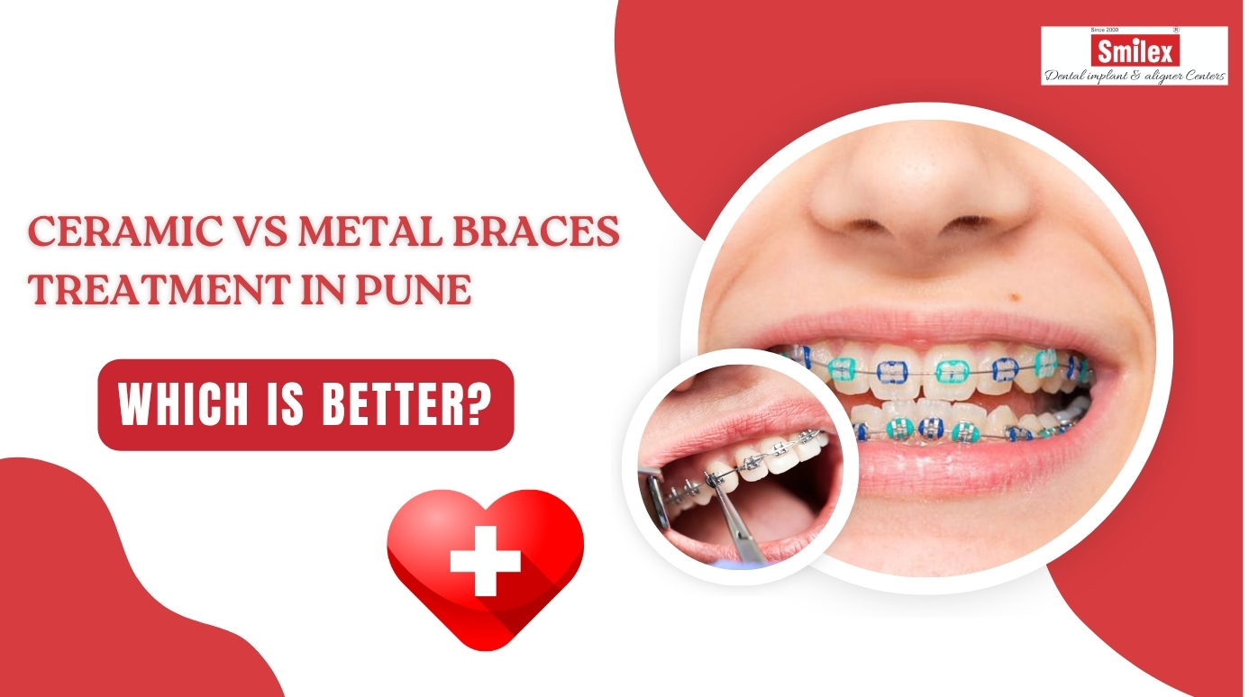 Braces Treatment