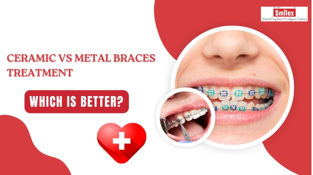 Braces Treatment