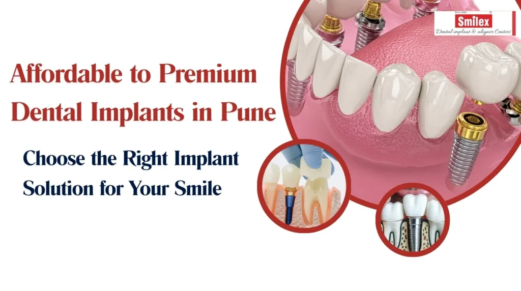 Dental Implants in Pune