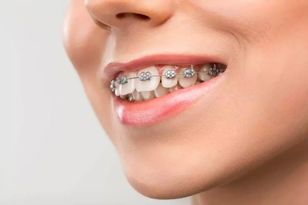 beautiful young woman with teeth braces 1