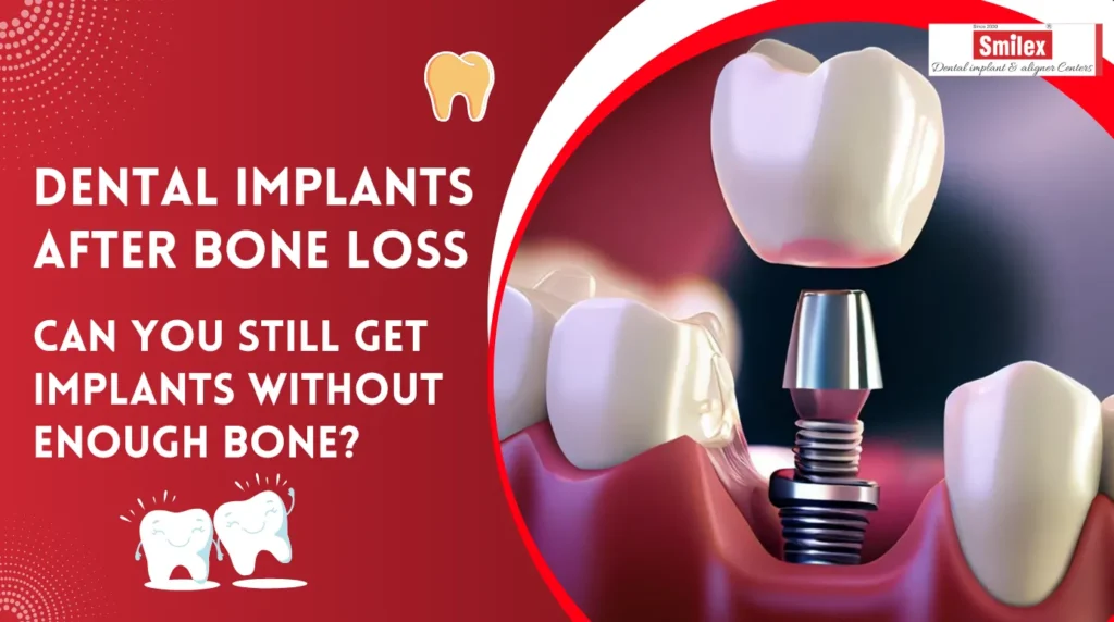 Dental Implants After Bone Loss