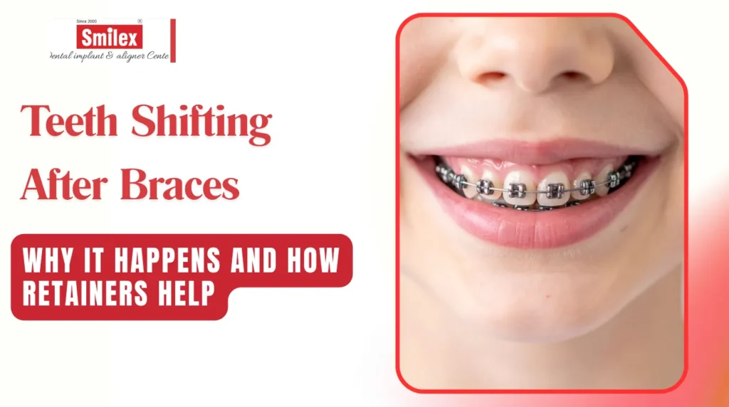 Teeth Shifting After Braces Treatment